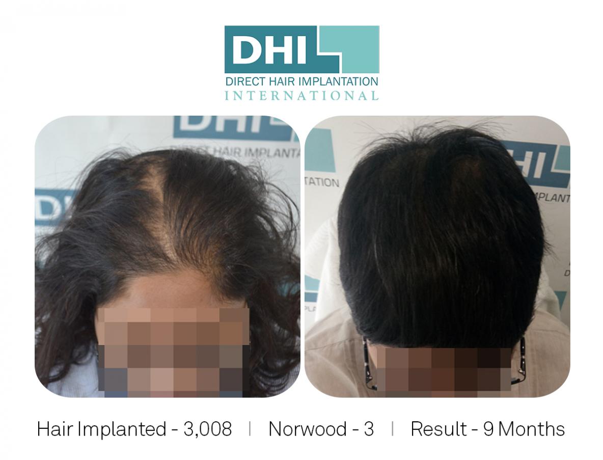 Norwood Scale 3, Hair implanted 3008. 
Female Hair Transplant Case.