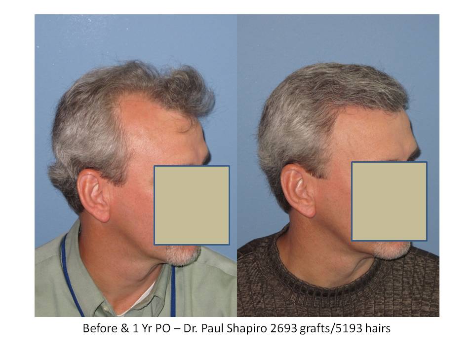 Dr. Paul Shapiro, MD  
FUT 
2693 grafts/5193 hairs 
12 months post-op