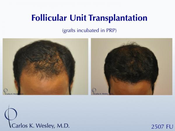 22-year-old male before and after 2507 grafts to the frontal third of his scalp by Dr. Carlos K. Wesley.  
 
A video montage of his transformation...