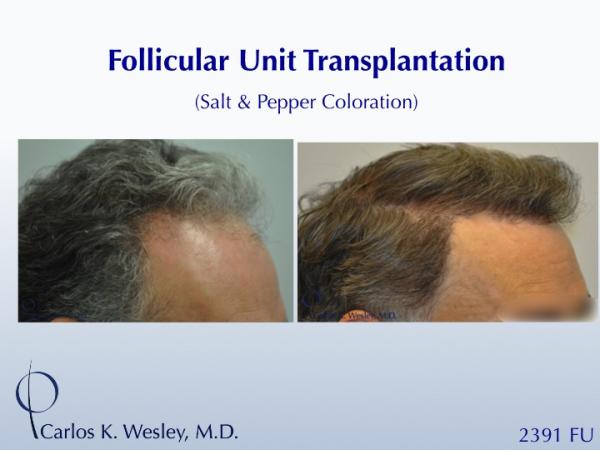 This patient is seen Before/After a 2391 graft 
session with Carlos K. Wesley, M.D. 
 
An interactive Before/After image of this patient can be...