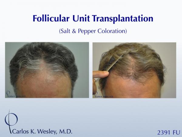 This patient is seen Before/After a 2391 graft 
session with Carlos K. Wesley, M.D. 
 
An interactive Before/After image of this patient can be...