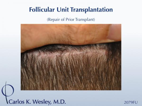 Donor scar after a 2079 micro graft repair session to soften the patient's "pluggy" hairline from a prior surgery with a different surgeon. 
 
An...