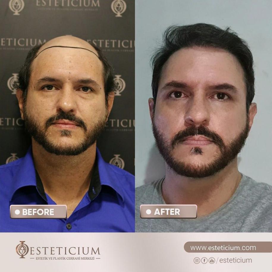 Hair Transplant Before - After