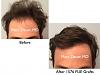 Click image for larger version

Name:	Hair Transplant Slides copy46.001.jpg

Size:	13.4 KB
ID:	45329