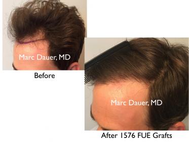 Click image for larger version

Name:	Hair Transplant Slides copy46.002.jpg

Size:	13.5 KB
ID:	45330