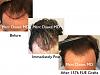 Click image for larger version

Name:	Hair Transplant Slides copy46.004.jpg

Size:	15.4 KB
ID:	45332