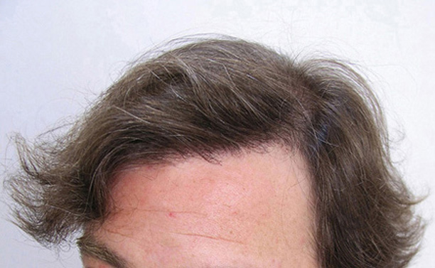 RESULT AFTER ONE FUT OF 1630 FOLLICULAR UNITS