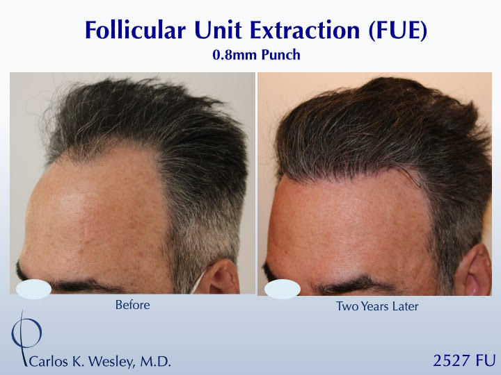 52-year-old man underwent a follicular unit extraction(FUE) session with Dr. Carlos K. Wesley in which a total of 2527 
 
CARLOS K. WESLEY, MD (NYC)...