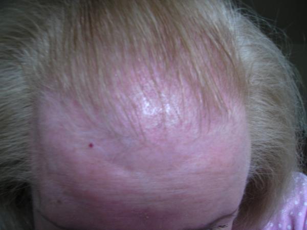 4d94554c883fb hairloss 060