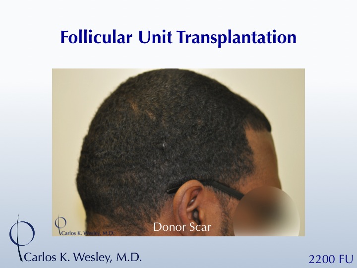 A 35-year-old African-American male underwent a 2200 FU session with Dr. Carlos K. Wesley (NYC).