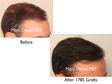 Click image for larger version

Name:	Hair Transplant Slides copy5.003.jpg

Size:	11.4 KB
ID:	43275