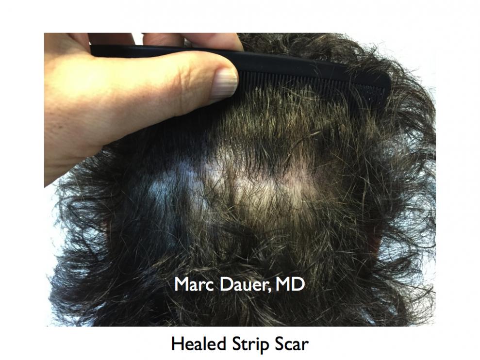 Click image for larger version

Name:	Hair Transplant Slides7.361.jpg

Size:	92.3 KB
ID:	36212