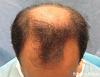 Click image for larger version

Name:	1096_10_3a_before-hair-transplant-top-view.jpg

Size:	24.3 KB
ID:	24047