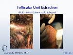 Images of the donor harvest from a 1283 FUE graft session from beard and scalp with Dr. Carlos K. Wesley in NYC. 
 
An interactive before/after image...