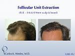 This patient had 1283 FUE grafts from beard and scalp with Dr. Carlos K. Wesley in NYC. 
 
An interactive before/after image can be viewed here:...