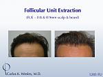 This patient had 1283 FUE grafts from beard and scalp with Dr. Carlos K. Wesley in NYC. 
 
An interactive before/after image can be viewed here:...