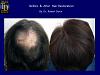 Crown hair transplant by Dr. Dorin