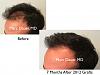 Click image for larger version

Name:	Hair Transplant Slides copy63.002.jpg

Size:	12.5 KB
ID:	47138