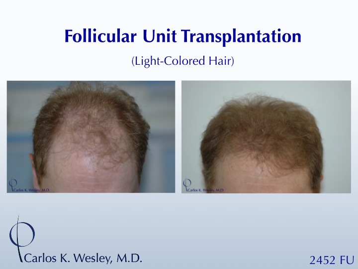 This patient can be seen before/after a 2452 grafts session with Dr. Wesley's office in NYC. 
 
An interactive before/after image of this patient can...
