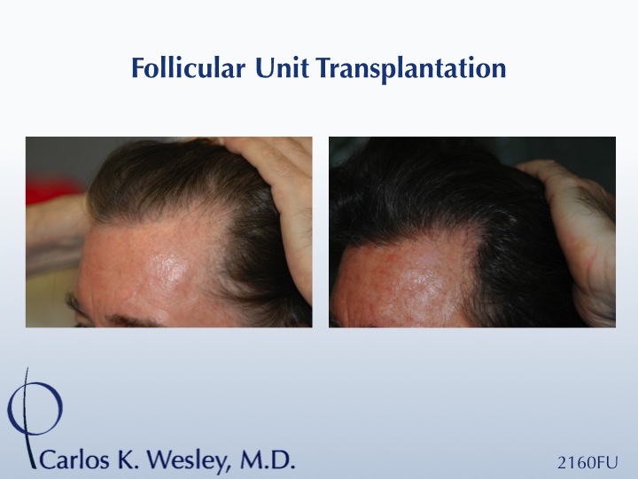 Before/After 2160 grafts 
Dr. Carlos K. Wesley in New York CitySlide2