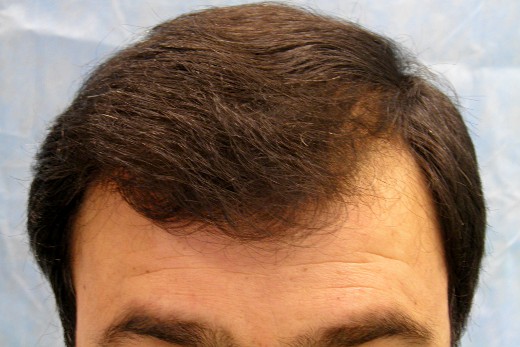 Click image for larger version

Name:	04_after-1st-hair-transplant.jpg

Size:	56.3 KB
ID:	7306