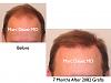 Click image for larger version

Name:	Hair Transplant Slides.263.jpg

Size:	57.3 KB
ID:	35170