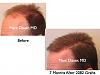 Click image for larger version

Name:	Hair Transplant Slides.264.jpg

Size:	58.4 KB
ID:	35172