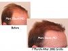 Click image for larger version

Name:	Hair Transplant Slides.265.jpg

Size:	58.5 KB
ID:	35173
