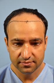 Click image for larger version

Name:	darling buds clinic hair transplant esult at 6 months in Indiia (4).jpg

Size:	8.1 KB
ID:	65984