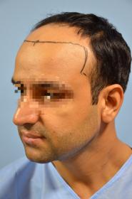Click image for larger version

Name:	darling buds clinic hair transplant esult at 6 months in Indiia (5).jpg

Size:	8.3 KB
ID:	65985