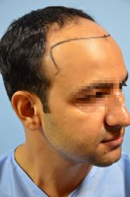 Click image for larger version

Name:	darling buds clinic hair transplant esult at 6 months in Indiia (9).jpg

Size:	8.7 KB
ID:	65986