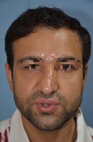 Click image for larger version

Name:	darling buds clinic hair transplant esult at 6 months in Indiia (2).jpg

Size:	7.8 KB
ID:	65988