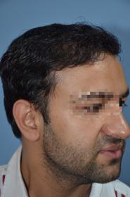 Click image for larger version

Name:	darling buds clinic hair transplant esult at 6 months in Indiia (1).jpg

Size:	8.0 KB
ID:	65989