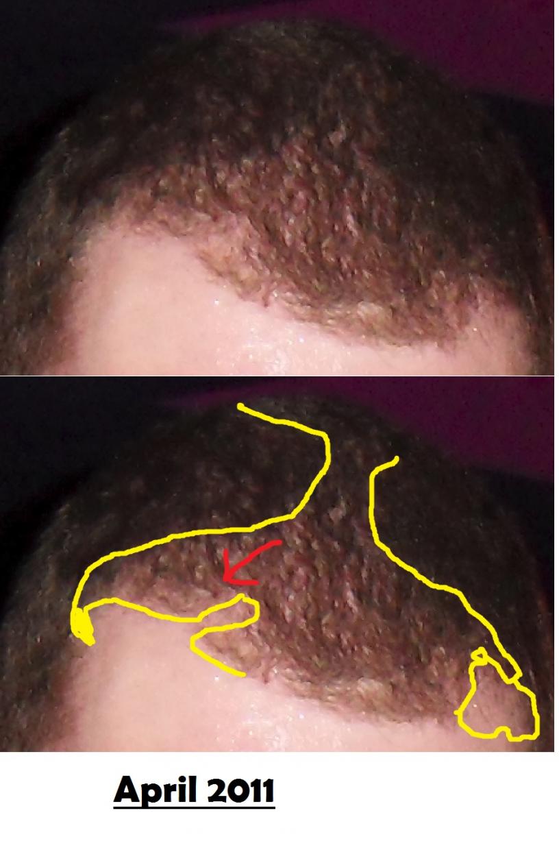 Click image for larger version

Name:	2 Hair loss beginning.jpg

Size:	85.0 KB
ID:	36890