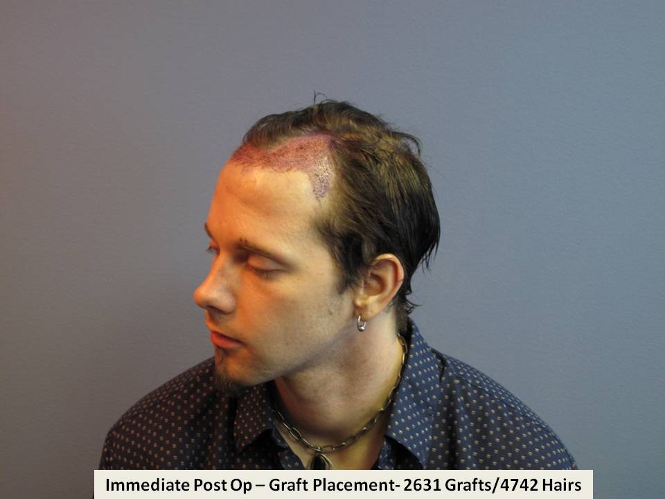 Dr. Paul Shapiro 
FUT 
2631 grafts/4742 hairs 
9 months post-op