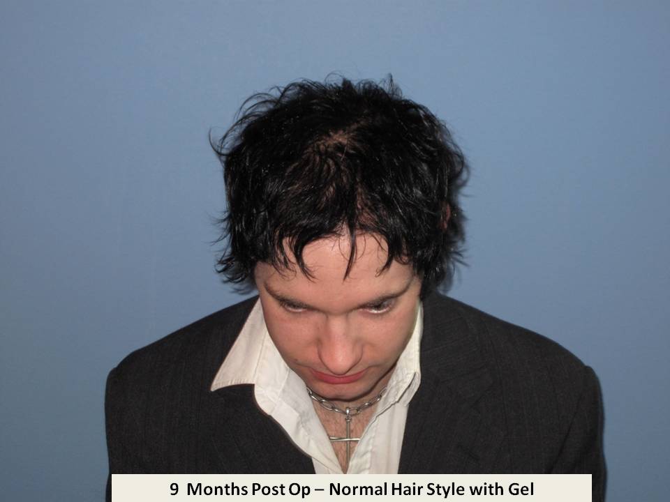 Dr. Paul Shapiro 
FUT 
2631 grafts/4742 hairs 
9 months post-op