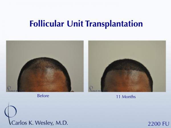 African-American male in his 30s underwent surgical hair restoration with Dr. Wesley (NYC).  Before and 11 months after a 2200 FU session.