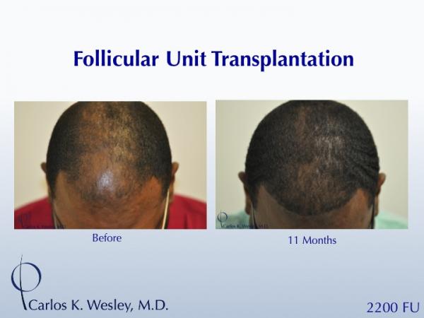 African-American male in his 30s underwent surgical hair restoration with Dr. Wesley (NYC).  Before and 11 months after a 2200 FU session.