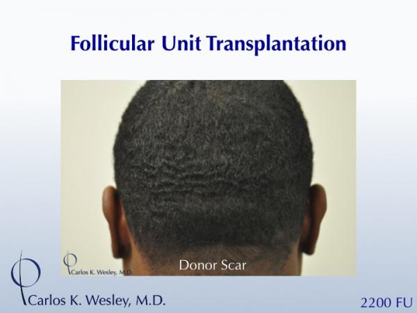 African-American male in his 30s underwent surgical hair restoration with Dr. Wesley (NYC).  Before and 11 months after a 2200 FU session.