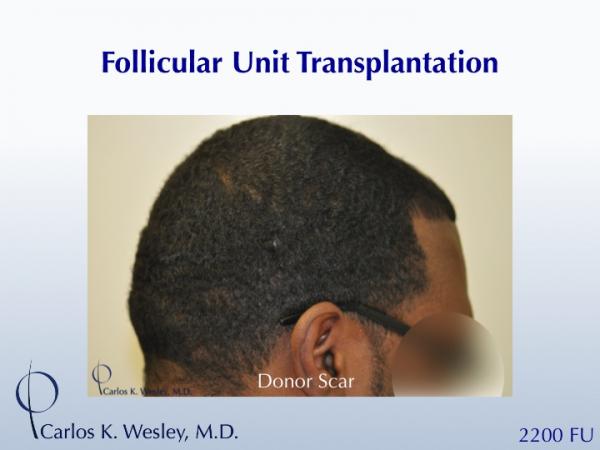 African-American male in his 30s underwent surgical hair restoration with Dr. Wesley (NYC).  Before and 11 months after a 2200 FU session.