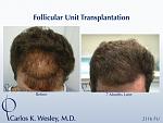 A 2116 graft session in Dr. Wesley practice in NYC.  
Wavy brown hair provides some of the best hair characteristics for more scalp coverage.