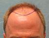 Click image for larger version

Name:	1b_position-of-hairline_rfr.jpg

Size:	90.3 KB
ID:	47287