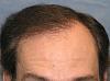 Click image for larger version

Name:	05_after-1st-hair-transplant-one-year.jpg

Size:	54.4 KB
ID:	7199
