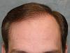 Click image for larger version

Name:	06_after-1st-hair-transplant-two-years.jpg

Size:	54.5 KB
ID:	7200