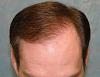 Click image for larger version

Name:	10_after-1st-hair-transplant-two-years-top-view.jpg

Size:	55.0 KB
ID:	7204