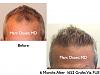Click image for larger version

Name:	Hair Transplant Slides9.257.jpg

Size:	65.1 KB
ID:	34776