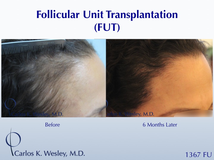 Female Hair Restoration