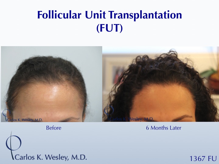 Female Hair Restoration