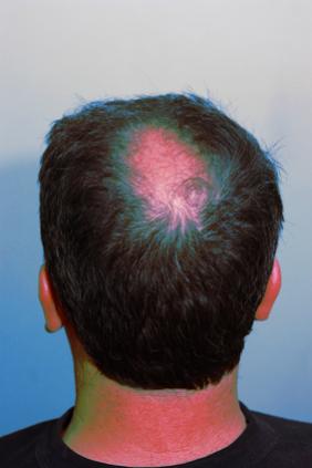 Click image for larger version

Name:	my balding spot.jpg

Size:	13.0 KB
ID:	49903