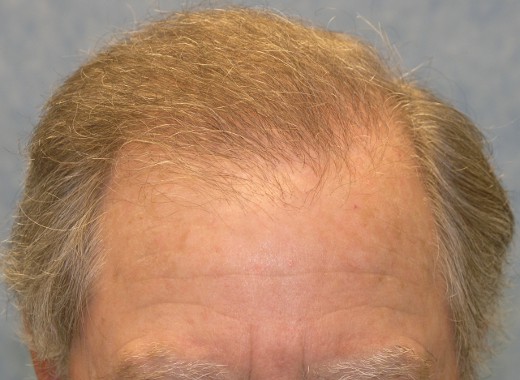 Click image for larger version

Name:	07_after-2nd-hair-transplant.jpg

Size:	55.8 KB
ID:	8900